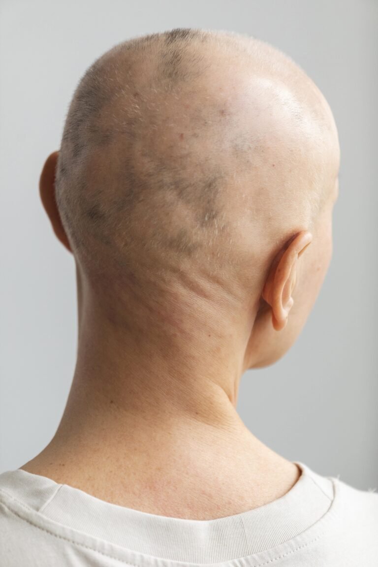 Mulher com alopécia areata